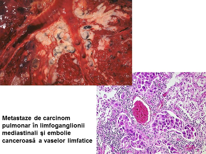Metastaze de carcinom  pulmonar în limfoganglionii  mediastinali şi embolie canceroasă a vaselor